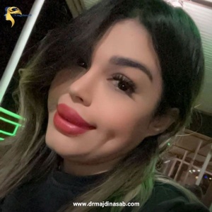Rhinoplasty-20