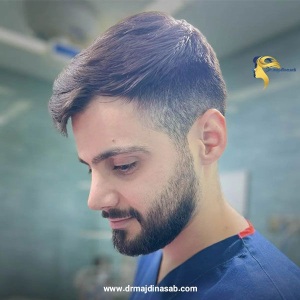 Rhinoplasty-23