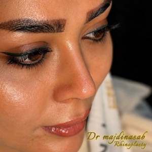 Rhinoplasty-50