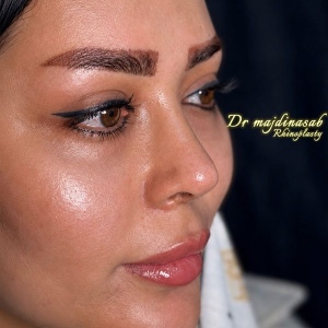 Rhinoplasty-51