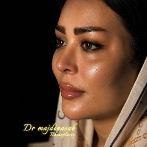 Rhinoplasty-52