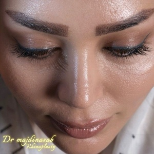Rhinoplasty-53