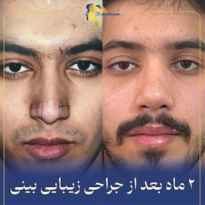 rhinoplasty13