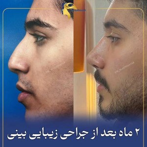 rhinoplasty14