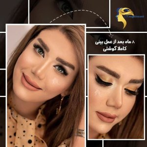 rhinoplasty2