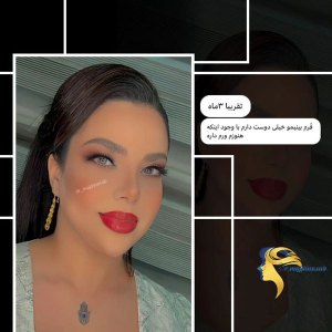 rhinoplasty4