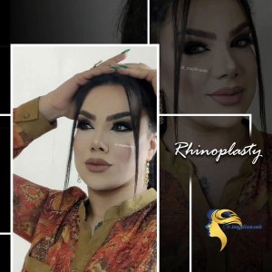 rhinoplasty5
