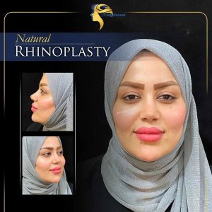 rhinoplasty6