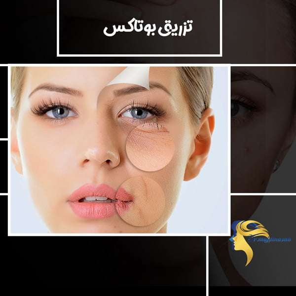 تزریق بوتاکس - دکتر نیلوفر مجدی نسب