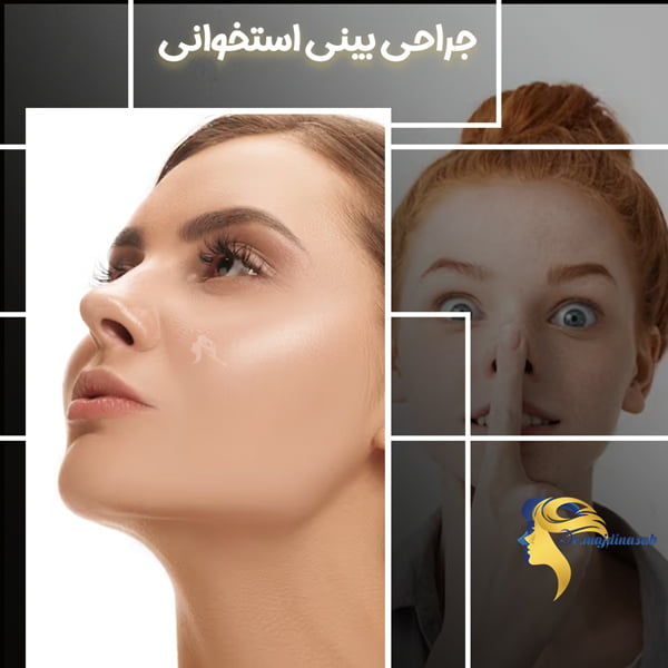 جراحی بینی استخوانی _ دکتر نیلوفر مجدی نسب