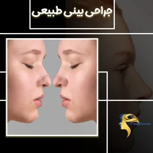 جراحی بینی طبیعی - دکتر نیلوفر مجدی نسب