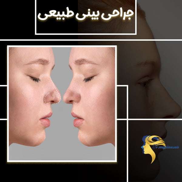 جراحی بینی طبیعی - دکتر نیلوفر مجدی نسب