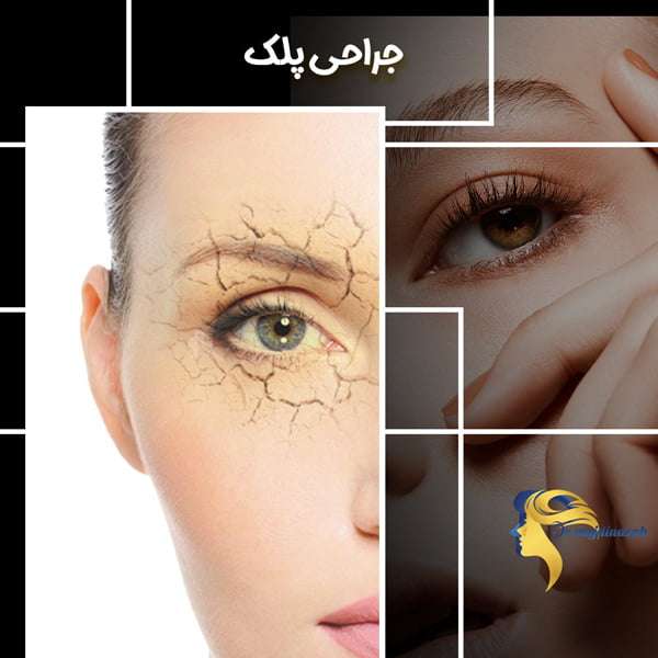 جراحی پلک - دکتر نیلوفر مجدی نسب
