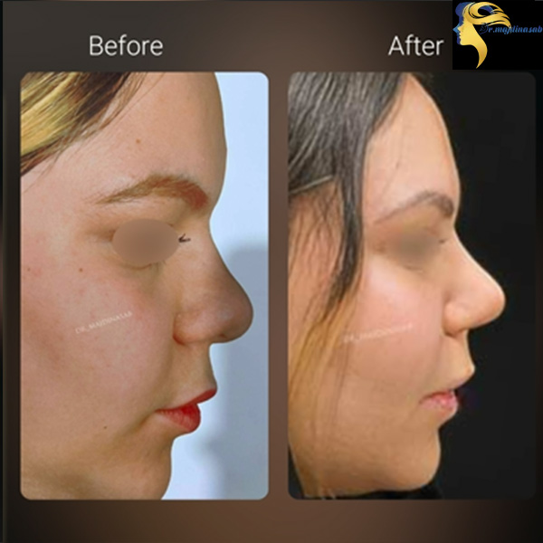 جراحی بینی گوشتی با پوست ضخیم - دکتر نیلوفر مجدی نسب