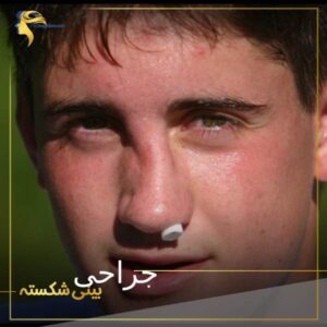 جراحی بینی شکسته