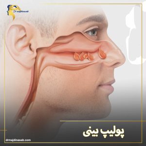 پولیپ بینی | دکتر نیلوفر مجدی نسب