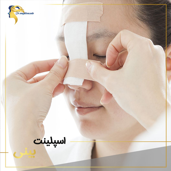 اسپلینت بینی - https://drmajdinasab.com/