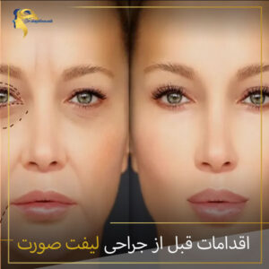 اقدامات قبل از جراحی لیفت صورت : دکتر نیلوفر مجدی نسب