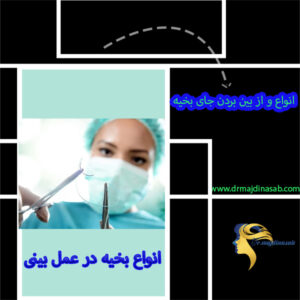 بخیه در عمل بینی - دکتر نیلوفر مجدی نسب