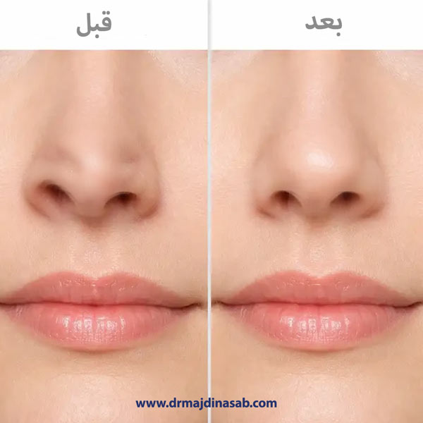 جراحی بینی ترمیمی + دکتر نیلوفر مجدی نسب