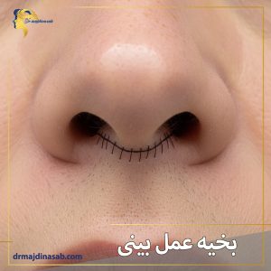 بخیه عمل بینی | دکتر نیلوفر مجدی نسب