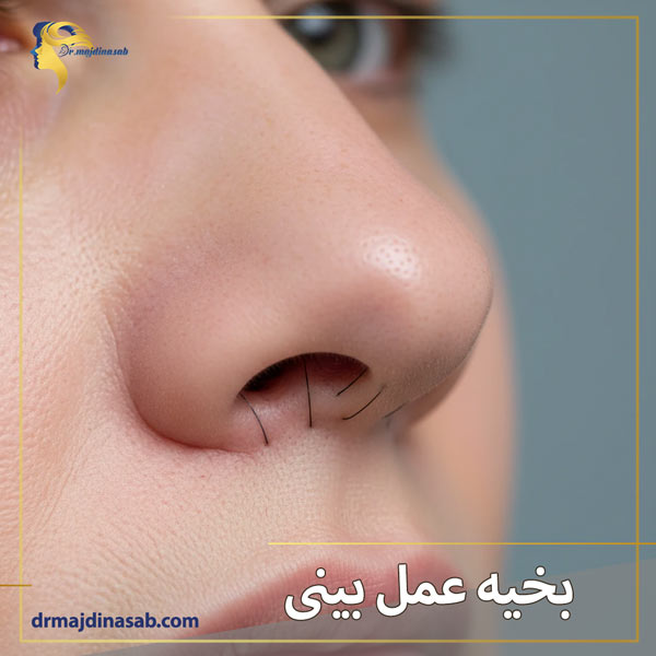 بخیه عمل بینی | دکتر نیلوفر مجدی نسب