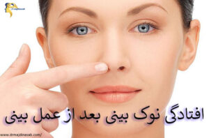 افتادگی نوک بینی بعد از عمل بینی - دکتر نیلوفر مجدی نسب