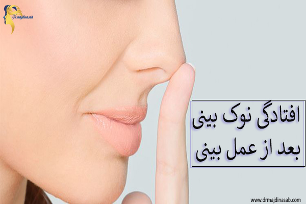 افتادگی نوک بینی بعد از عمل بینی - دکتر نیلوفر مجدی نسب