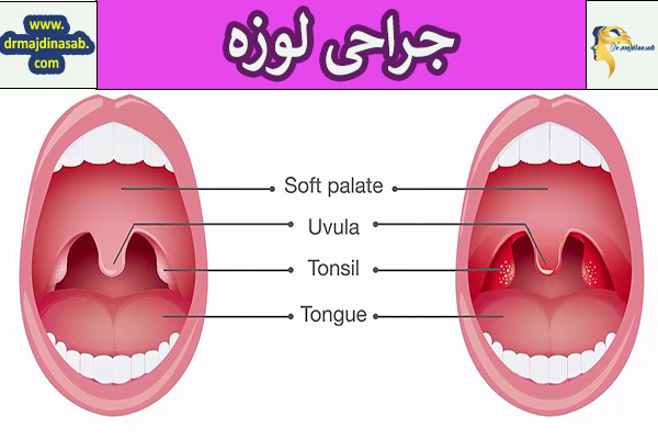جراحی لوزه - دکتر نیلوفر مجدی نسب