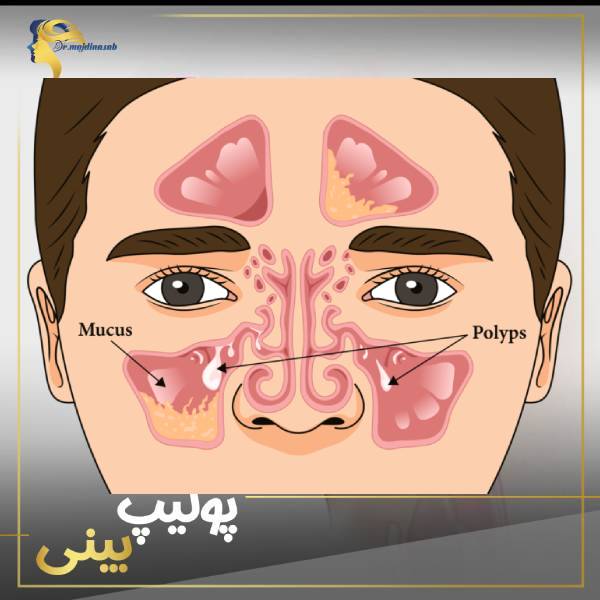 عکس پولیپ بینی - دکتر نیلوفر مجدی نسب