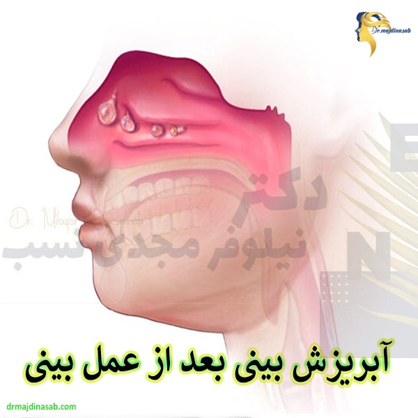 عکس آبریزش بینی بعد از عمل - دکتر نیلوفر مجدی نسب