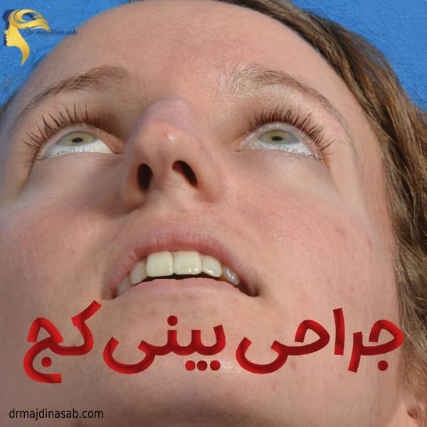 عکس جراحی بینی کج - دکتر نیلوفر مجدی نسب