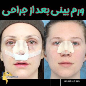 ورم بینی بعد از جراحی