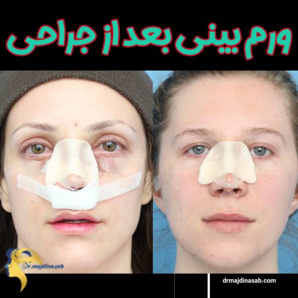 عکس ورم بینی بعد از جراحی