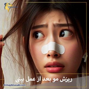 ریزش مو بعد از عمل بینی