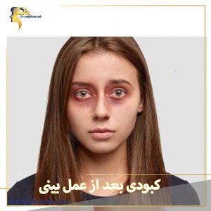 کبودی بعد از عمل بینی