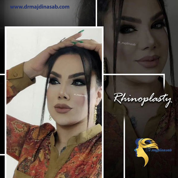 نتایج جراحی بینی دکتر نیلوفر مجدی نسب