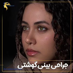 جراحی بینی گوشتی در تهران + دکتر نیلوفر مجدی نسب