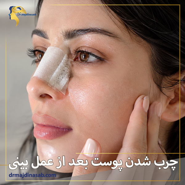 چرب شدن پوست بعد از عمل بینی + دکتر نیلوفر مجدی نسب
