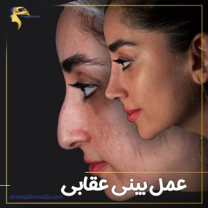 عمل بینی عقابی | دکتر نیلوفر مجدی نسب